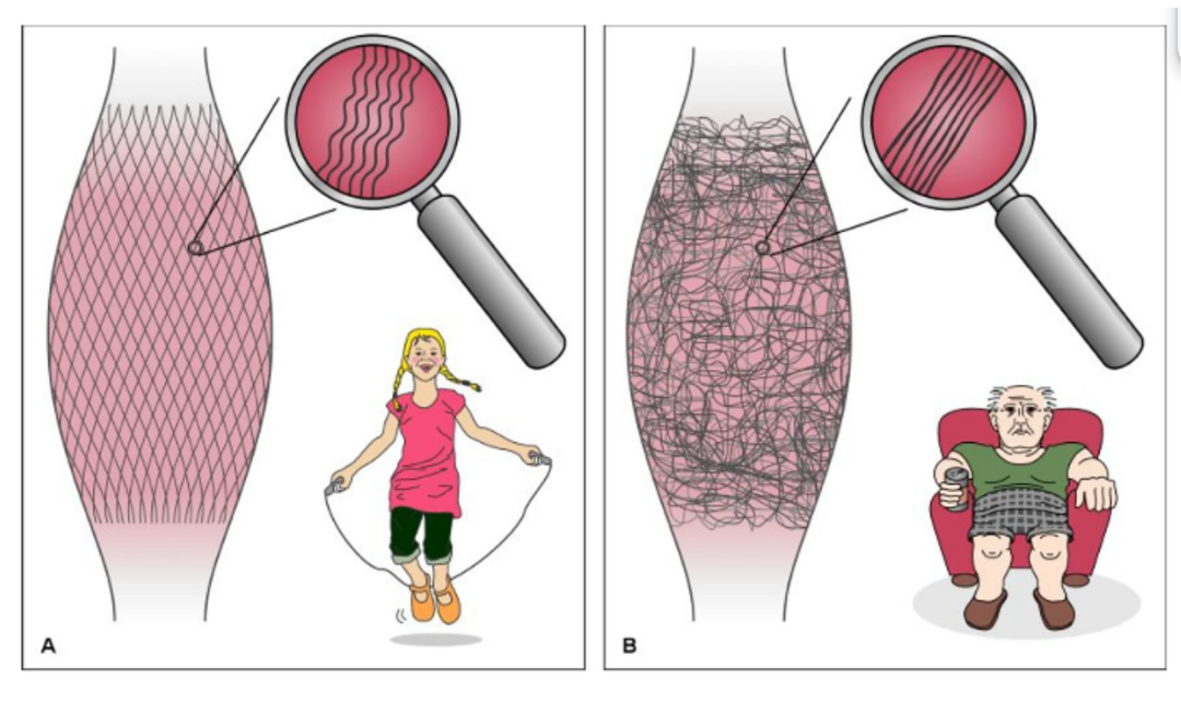 Fasyal sağlığın karşılaştırmalı illüstrasyonu: aktif bir çocuğun düzenli, elastik fasyası ile hareketsiz yaşamdaki yoğun, lifli ve kısıtlanmış fasya, büyütülmüş detaylarla gösteriliyor